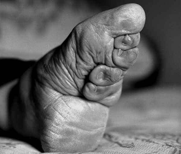 Foot binding