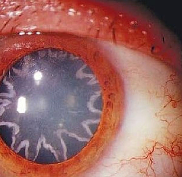 Strange star pattern develops on man’s eyes