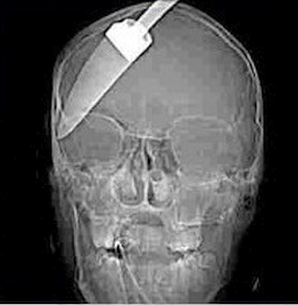 A 5-inch knife inside a teenager’s head